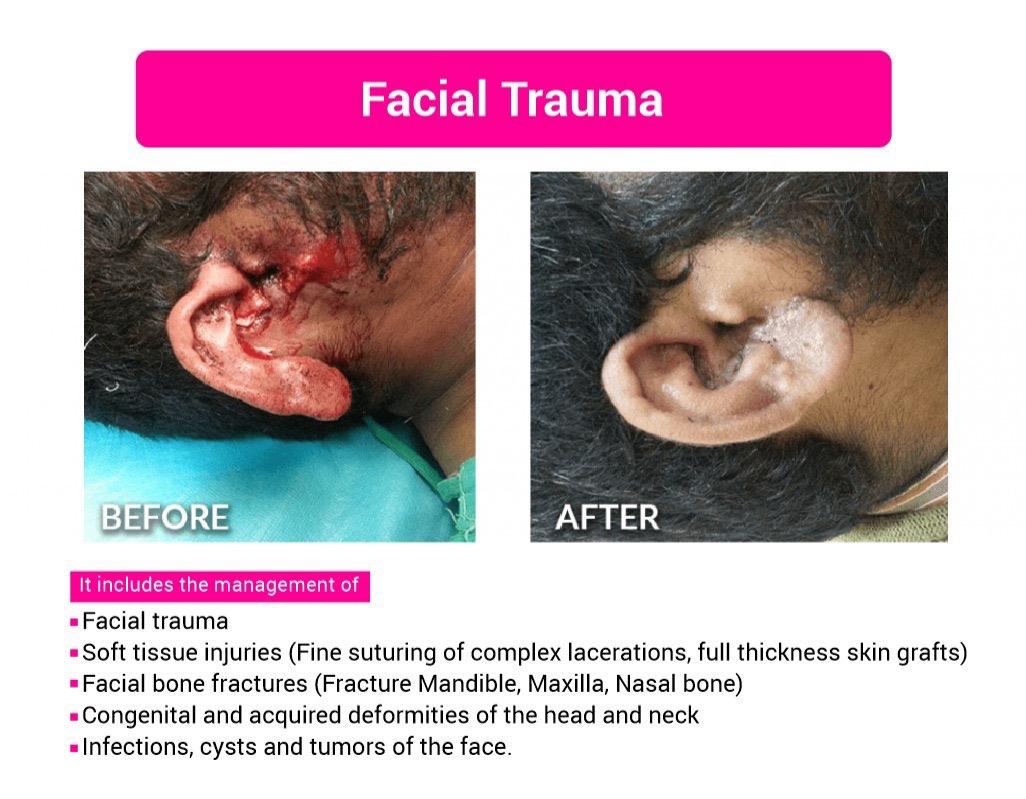 Facial Trauma