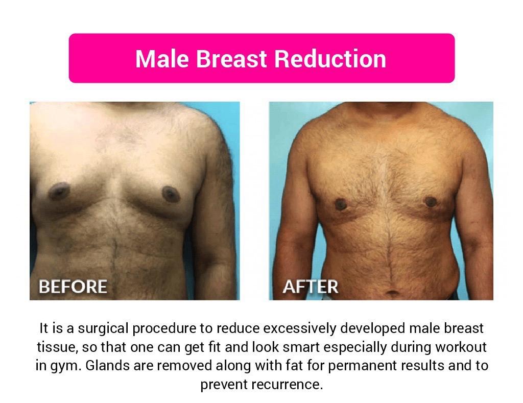 Male Breast Reduction