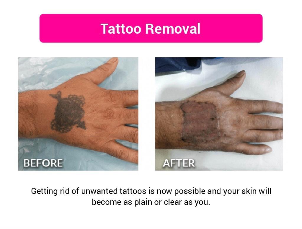 Tattoo Removal Before & After